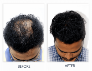 Hair Transplant 