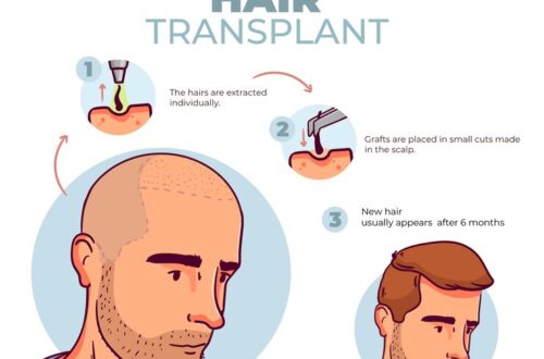 Hair Transplant Clinic in Nashik