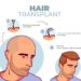 Hair Transplant Clinic in Nashik