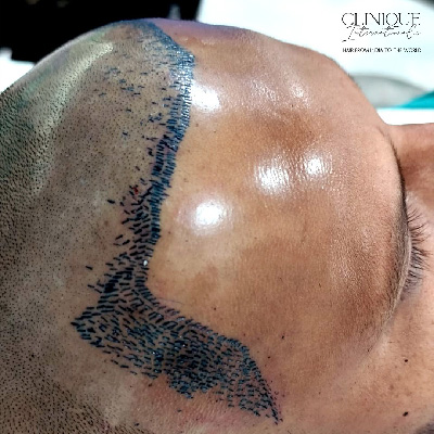 Hair Transplant Treatment