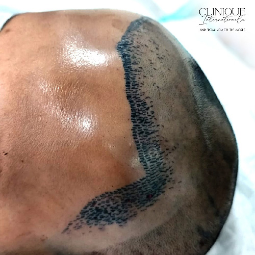 Hair Transplant Treatment